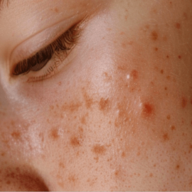 Acne, inflamed acne skin
