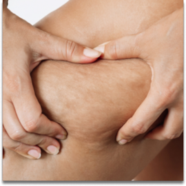 Cellulite