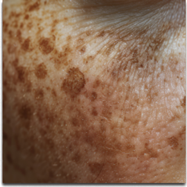 Age spot, pigment spot